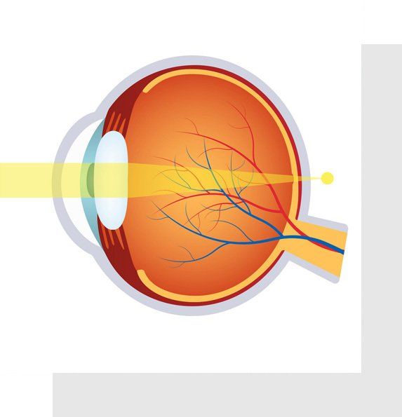 Hyperopia Symptoms Causes Diagnosis Treatment Texas Eye and